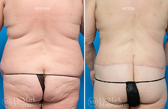 Bodylift - Lowerbody- Obese - 4