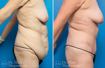 Bodylift - Lowerbody- Overweight - 1