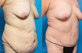 Bodylift - Lowerbody- Overweight - 2