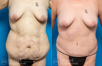 Bodylift - Lowerbody- Overweight - 3