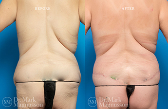 Bodylift - Lowerbody- Overweight - 4