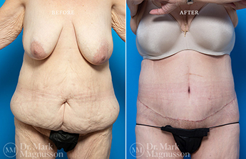 Bodylift - Lowerbody- Overweight - 5