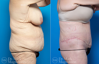 Bodylift - Lowerbody- Overweight - 6