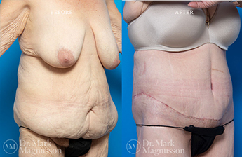 Bodylift - Lowerbody- Overweight - 7