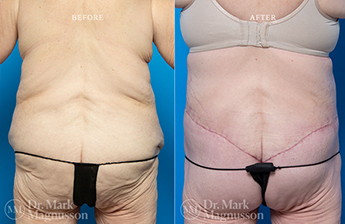 Bodylift - Lowerbody- Overweight - 8