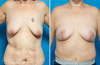 Bodylift - Lowerbody- Overweight - 9