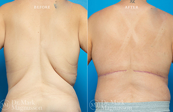 Bodylift - Lowerbody- Overweight - 10