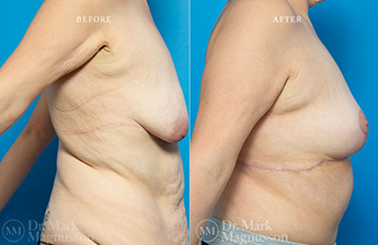 Bodylift - Lowerbody- Overweight - 11