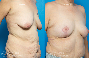 Bodylift - Lowerbody- Overweight - 12