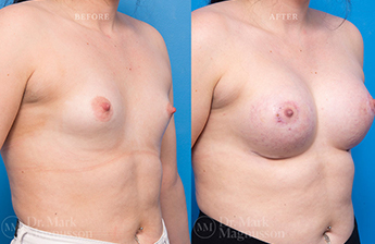 Breast Implants - 1
