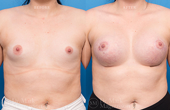 Breast Implants - 2