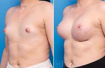 Breast Implants - 3