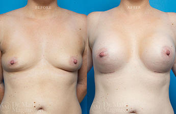 Breast Implants - 4