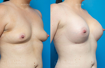 Breast Implants - 5