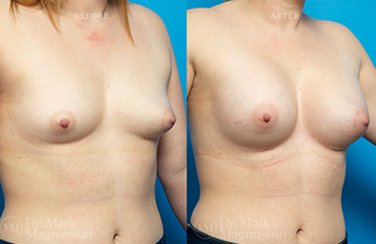 Breast Implants - 7