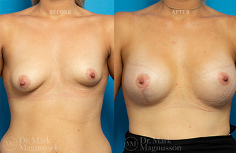 Breast Implants - 8