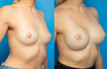 Breast Implants - 11
