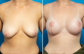 Breast Implants - 12
