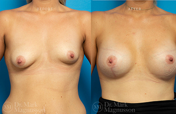 Breast Implants Mastopexy - 9