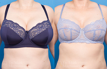 Breast Reduction - 5