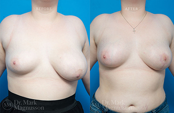 Breast Reduction + Breast Implant - 1