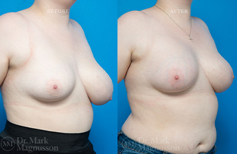 Breast Reduction + Breast Implant - 2