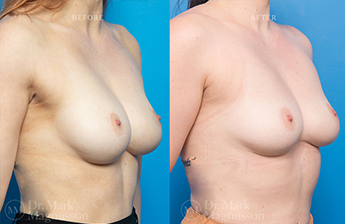 Breast implant Revision - Breast Augmentation - Removal of Implants - 2