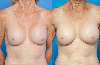 Breast implant Revision - Breast Augmentation - RR - 1