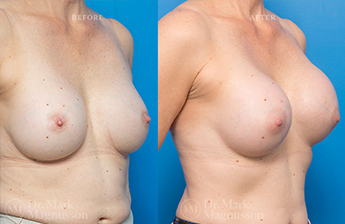 Breast implant Revision - Internal Bra - 2