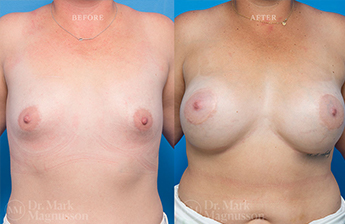 Breast implant Revision - Internal Bra - 3