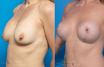 Breast implant Revision - Breast Augmentation - Internal Bra - 2