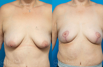 Breast Reconstruction - Asymmetry After Cancer - 1