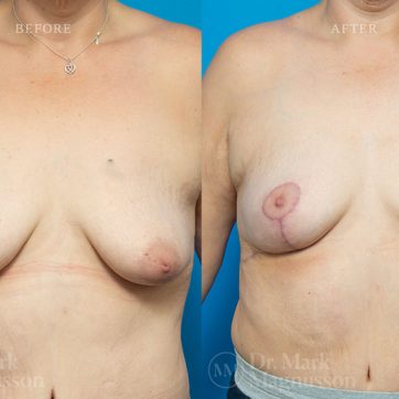 Breast_Reconstruction-Asymmetry_After_Breast_Cancer_Treatment_001@2x