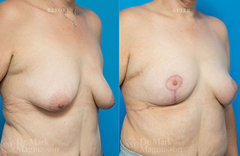 Breast Reconstruction - Asymmetry After Cancer - 2