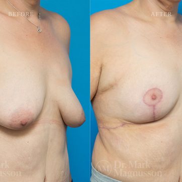 Breast_Reconstruction-Asymmetry_After_Breast_Cancer_Treatment_002@2x