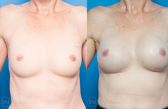 Breast Reconstruction - Composite Breast - 1