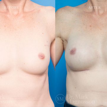 Breast_Reconstruction-Composite_Breast_Reconstruction_001@2x