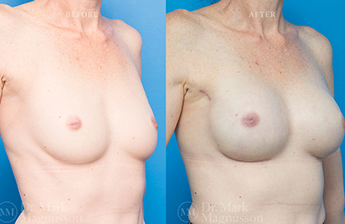 Breast Reconstruction - Composite Breast - 2