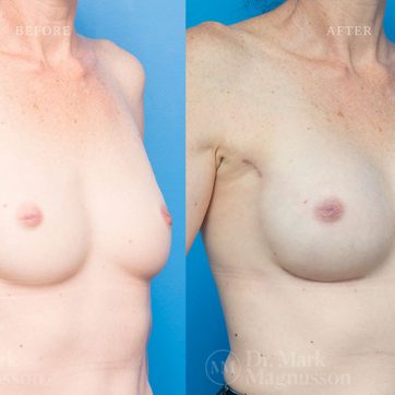 Breast_Reconstruction-Composite_Breast_Reconstruction_002@2x