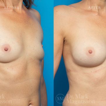 Breast_Reconstruction-Composite_Breast_Reconstruction_004@2x