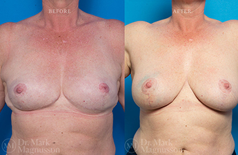 Breast Reconstruction - Composite Breast - 6