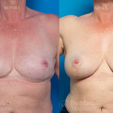 Breast_Reconstruction-Composite_Breast_Reconstruction_006@2x