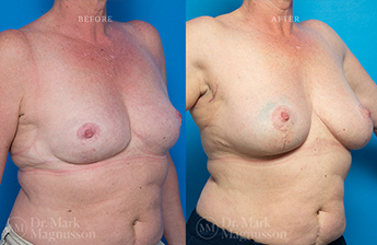 Breast Reconstruction - Composite Breast - 7