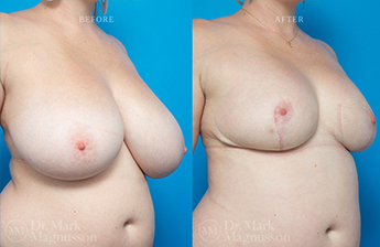 Breast Reduction - Obese - 6