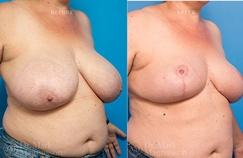 Breast Reduction - Obese - 20