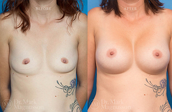 Dev Breast Problems - Chest Wall Deformity - 1