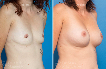 Dev Breast Problems - Chest Wall Deformity - 2