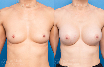 Dev Breast Problems - Chest Wall Deformity - 7