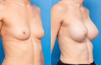 Dev Breast Problems - Chest Wall Deformity - 8