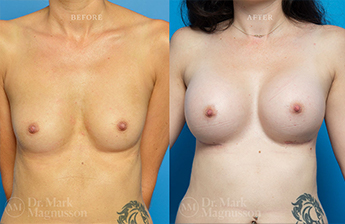 Dev Breast Problems - Chest Wall Deformity - 9